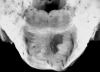 Recent and cavitated lacunar infarcts